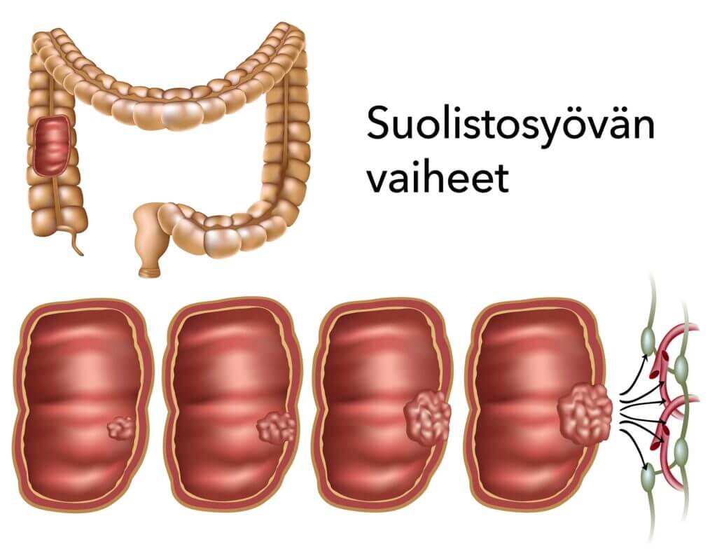Suolistosyöpä ja sen vaiheet