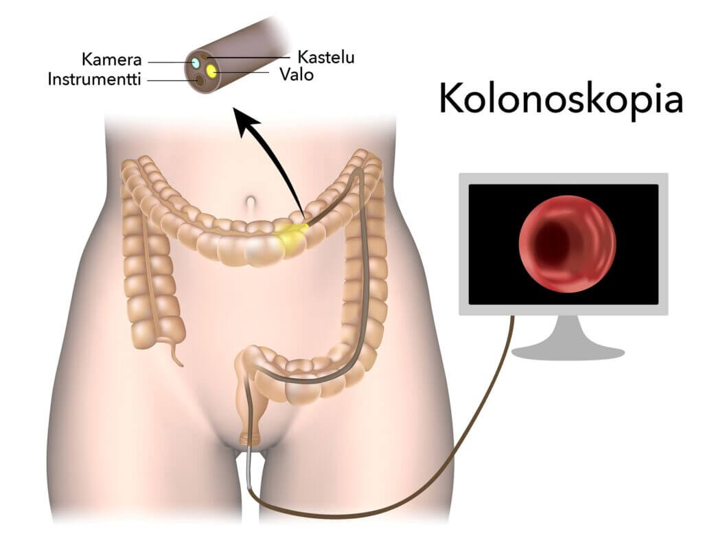 Paksusuolen tähystys