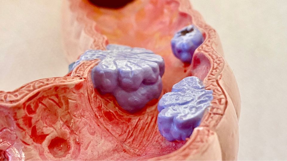 Suolistosyöpä ennuste ja oireet